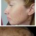 Коричневые пятна на лице: причины появления и методы лечения