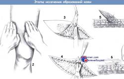Кровопускание – китайское, тибетское, европейское, исламское, польза и вред, показания и противопоказания, лечение заболеваний, точки для кровопускания